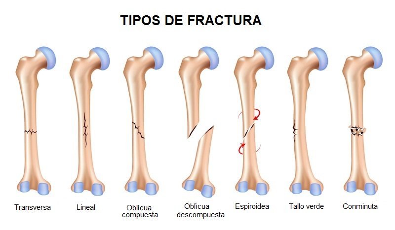 Los diferentes tipos de fracturas