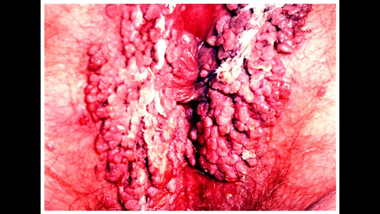 Penyakit Herpes Pada Kelamin  Wanita jualanobatherbal