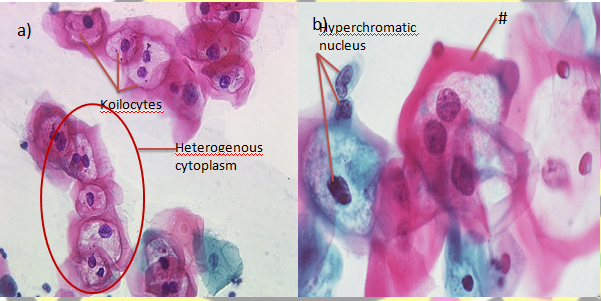 Analize Human Papilloma Virus (HPV)