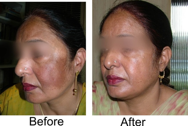 Beauty Tips &amp; Personal Health Care: Pigmentation on face 