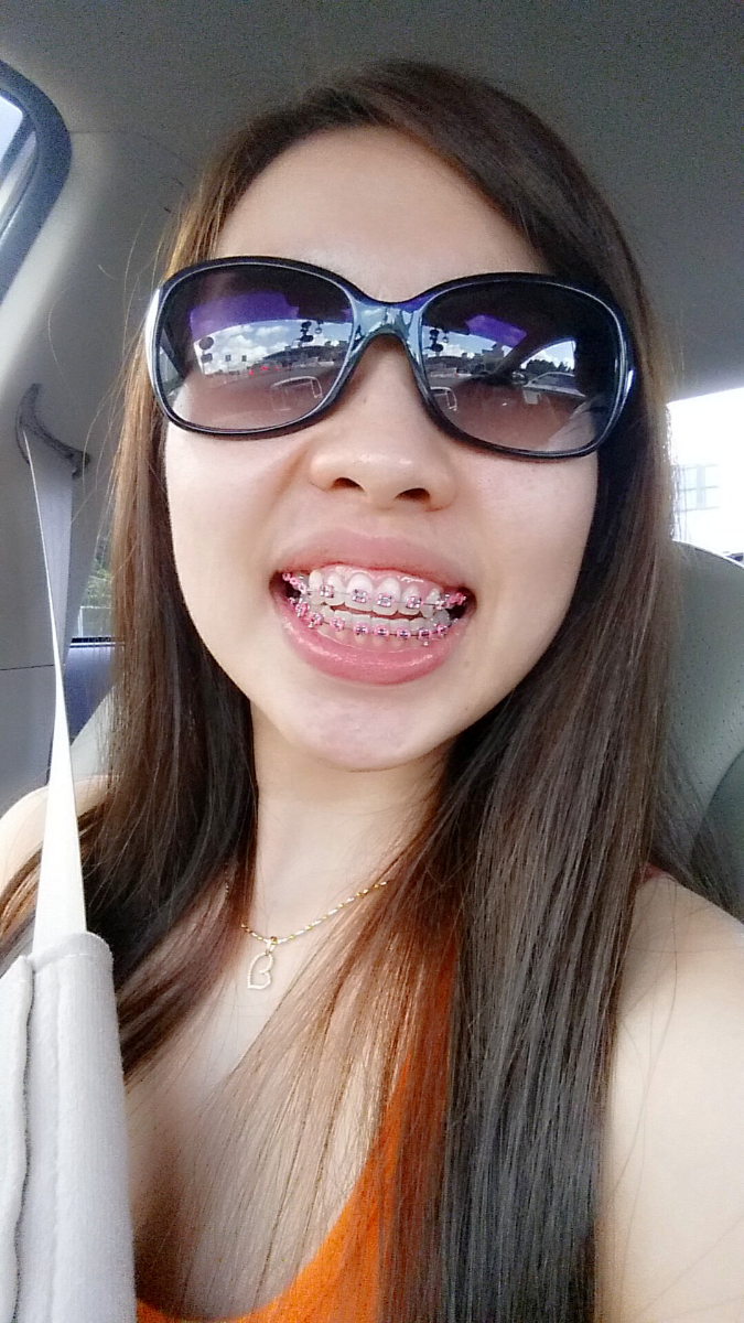 My Braces Experience Junique Lee
