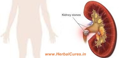 10 Natural Home Remedies for Kidney Stones - Herbal Cures