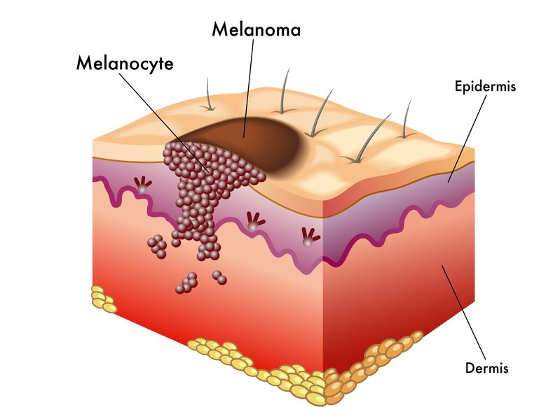 Il melanoma cutaneo un nemico silenzioso