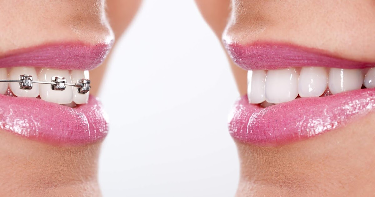 Invisalign An Alternative to Metal Braces