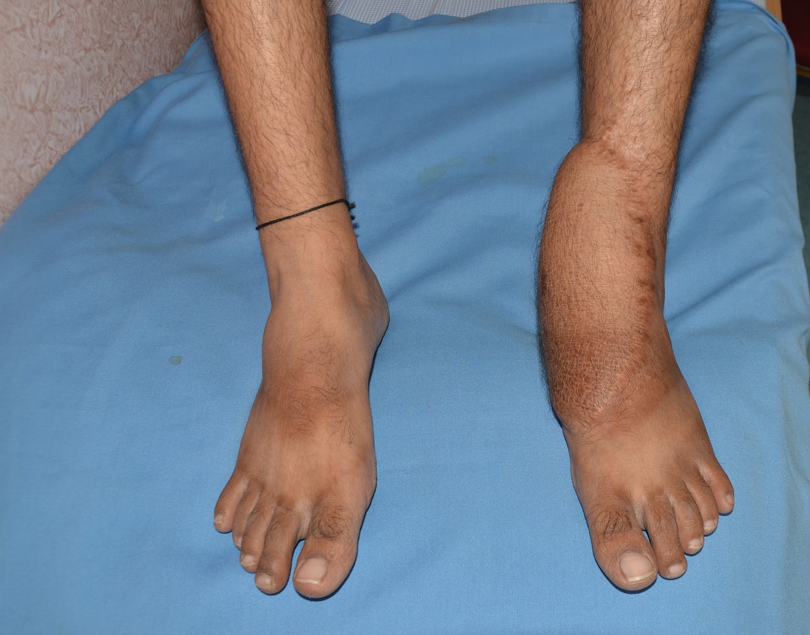 CRUSH INJURY FOOT HEEL PAD DEGLOVING MEDIAL MALLEOLI AND TIBIALIS
