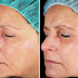 The Benefits Of Total Laser Resurfacing