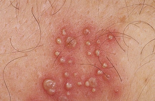 herpes on the buttocks outbreak pictures