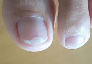 Fu0nagelpilz, Nagelkrankheiten erkennen, Jenn Cosmetic Hohlraum unter dem nagel