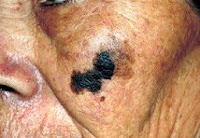 cuales son los sintomas del cancer de piel