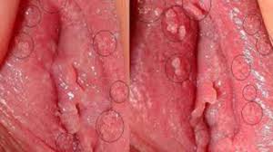 Image Cara Ampuh Mengobati Vagina luka