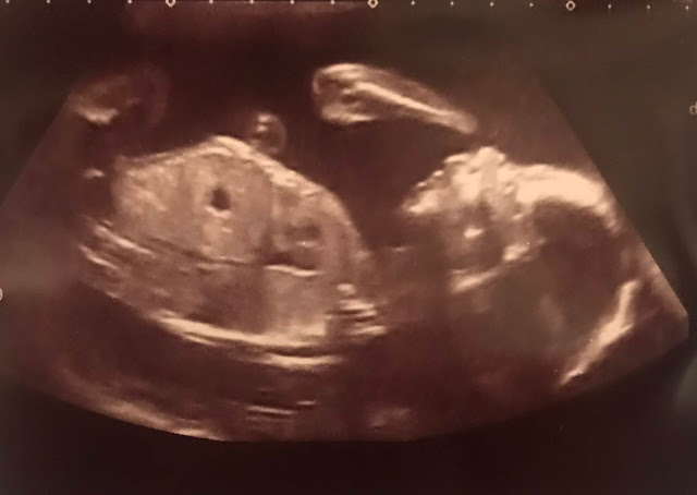 An ultrasound image of a baby 