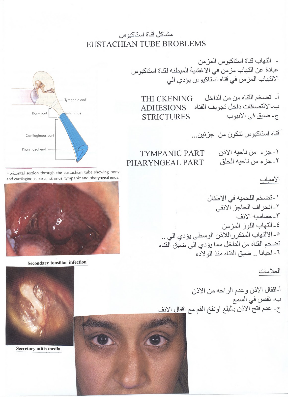 المدونة الطبية د فهيد سالم السبيعي مشاكل قناة استاكيوس Eustachian Tube Dysfunction