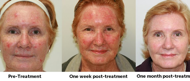 photodynamic therapy for skin cancer images