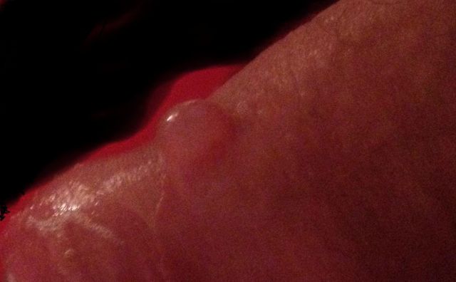 Blisters On Tip Of Penis 43