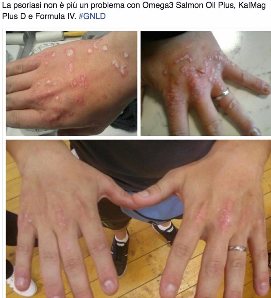 Con - proteina a reazione a eczema