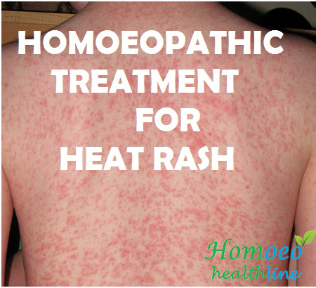 Homoeo Health Line Heat Rash Miliaria Homoeopathic Treatment