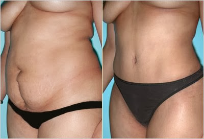 flacidez da pele e flacidez na barriga como perder a vergonha da flacidez no corpo abdominoplastia antes e depois