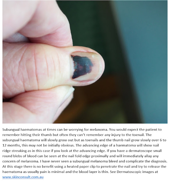 Consultations in Dermatology Subungual Haematoma