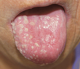 Obat Penyakit Herpes pada Lidah