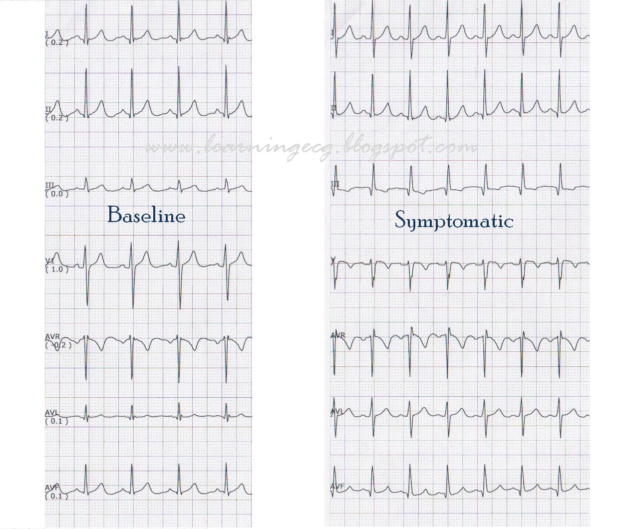 ECG Rhythms Pulmonary Embolism on Telemetry