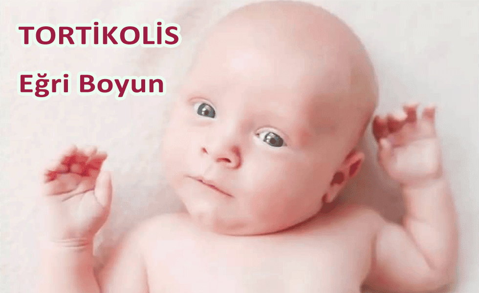 Bebeklerde TORTİKOLİS (Eğri Boyun) Hastalığı