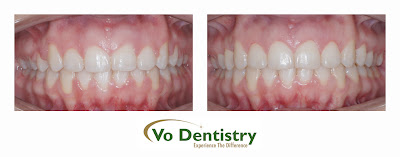 Gum surgery, dental laser surgery, gingivectomy, lawrenceville, GA 30043