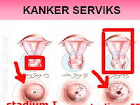 Obat Kanker Rahim Tradisional Obat Kanker Rahim Tradisional