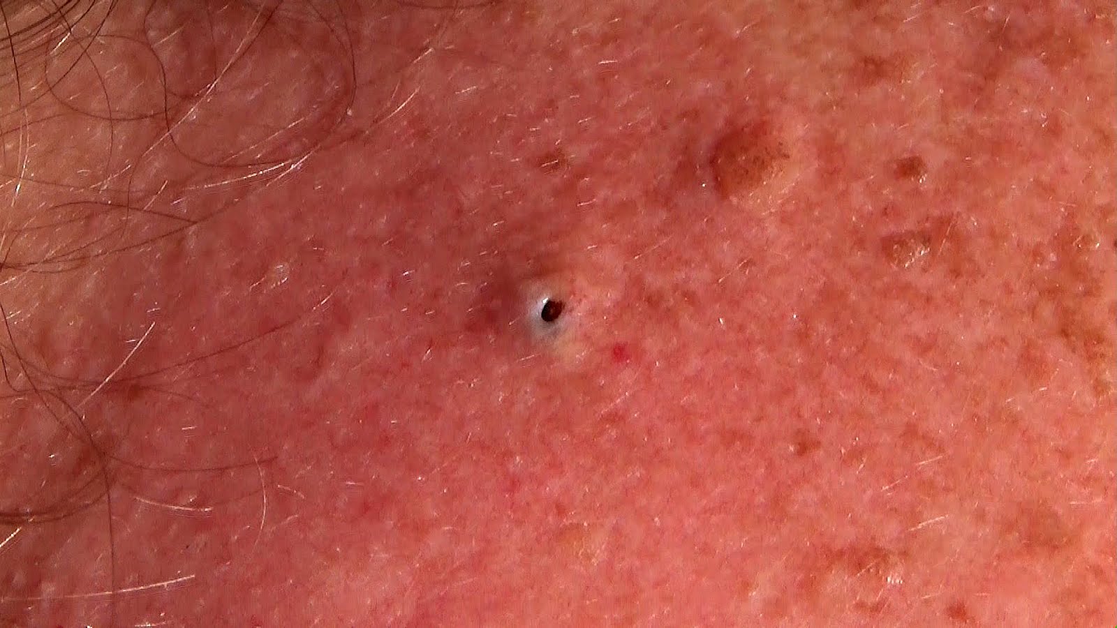 What Comes Out Of A Blackhead Black Choices