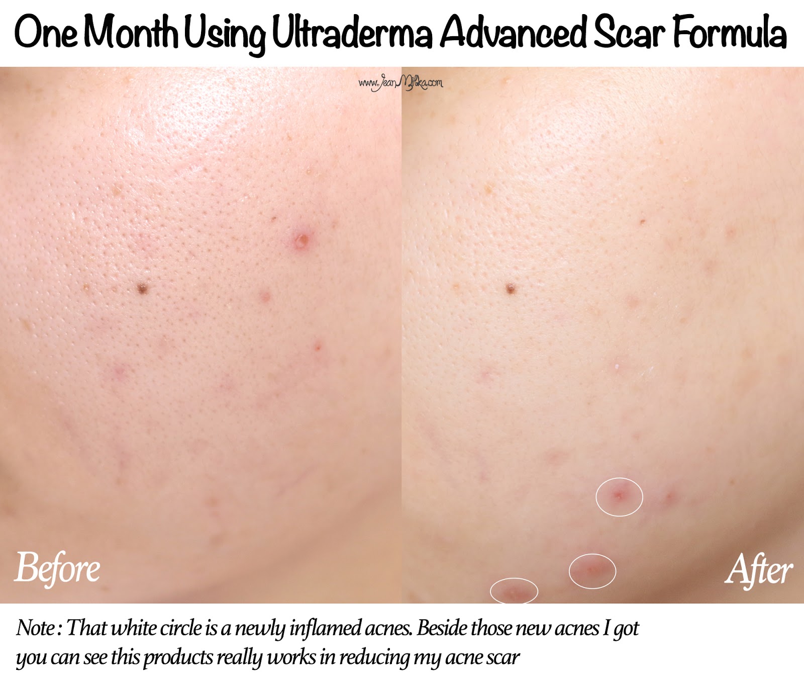 review ultraderma advanced scar formula jean milka review ultraderma advanced scar formula jean milka