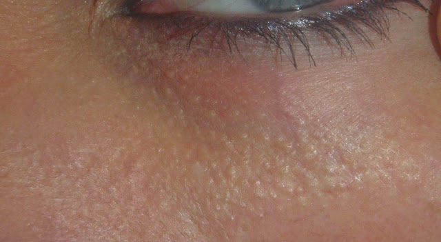 white bumps under eye