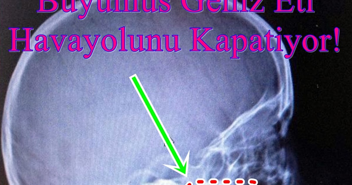 geniz eti iltihabı