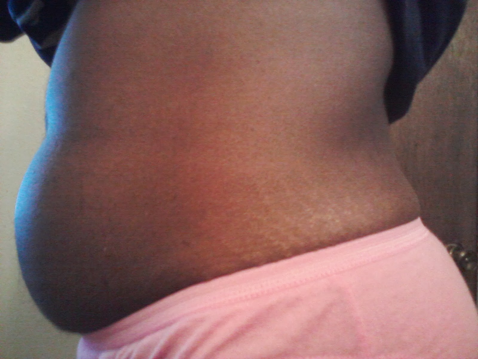 Natural remedies for shrinking fibroids Natural remedies for shrinking fibroids