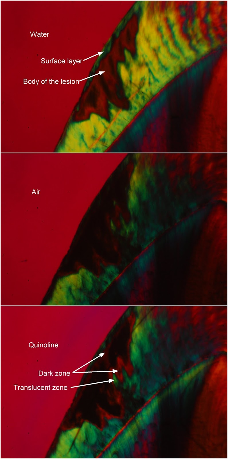Polarizing microscopy of dental enamel and caries histopathology Dark