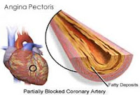 Cara Mengobati Angina Pectoris