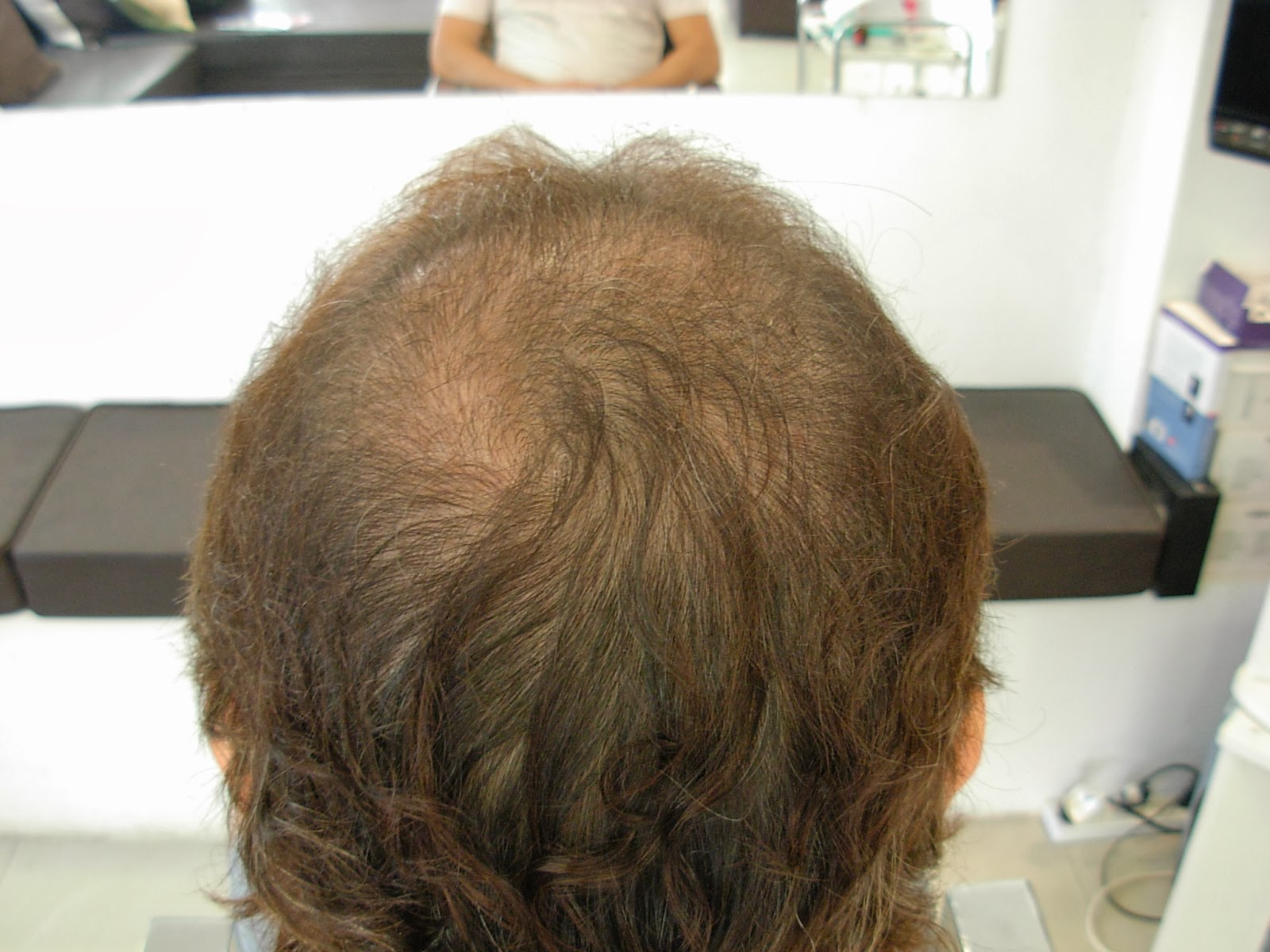 Recuperacion Capilar Medical Hairs Ap Casos exitosos