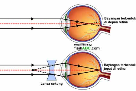 miopie complicată de astigmatism