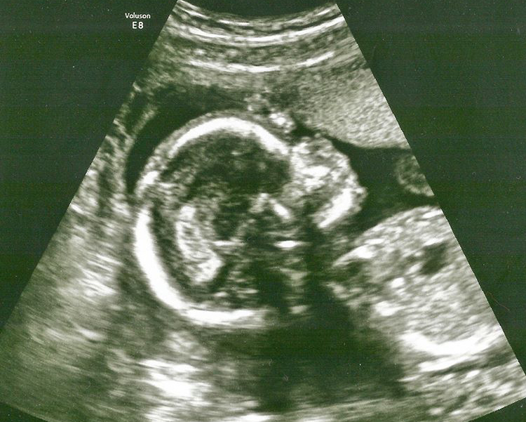 19 Haftalık Gebelik Ultrason Görüntüleri