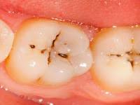 Cara Mencegah Gigi Berlubang Secara Alami 