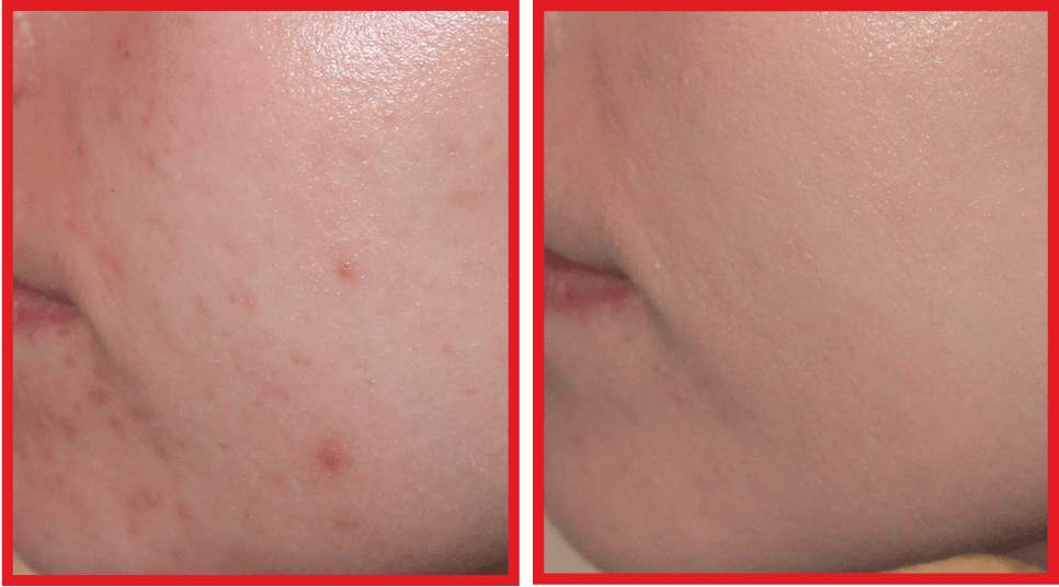 comment appliquer toleriane