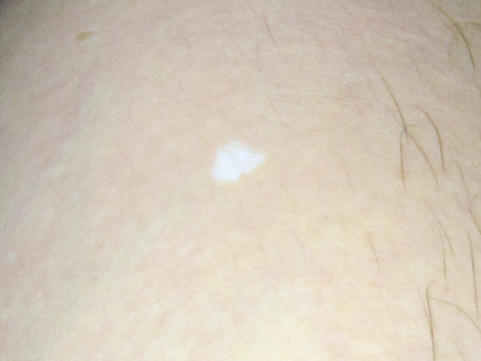 雑談散歩 日に焼けたら老人性白斑が目立ってきた