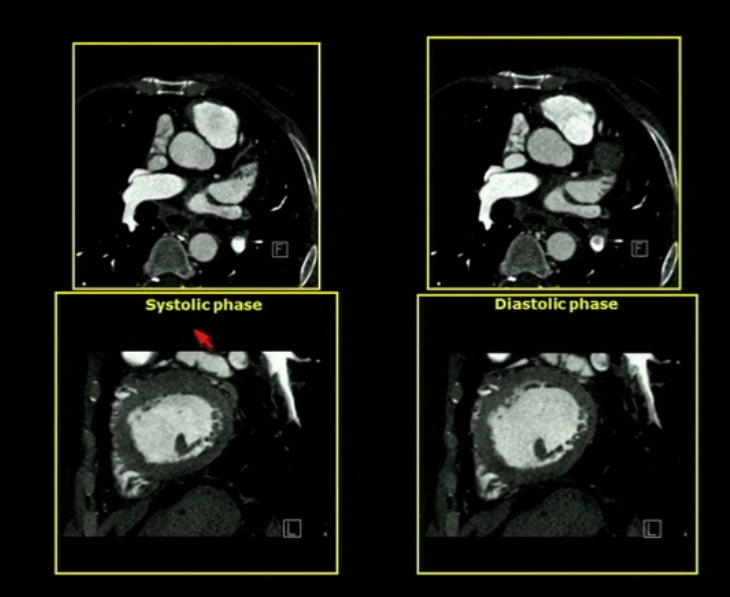 rsna heart on thoracic imaging