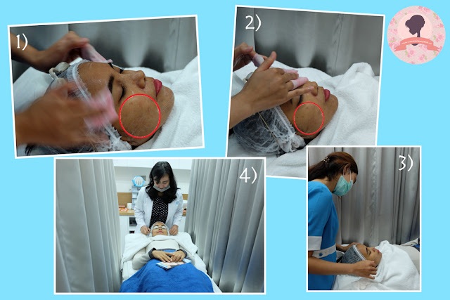 Proses-pembersihan-wajah-pra-treatment-PPP-laser