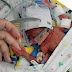 El bebé más pequeño del mundo: Nació con menos de medio kilo y tuvo que ser operado 