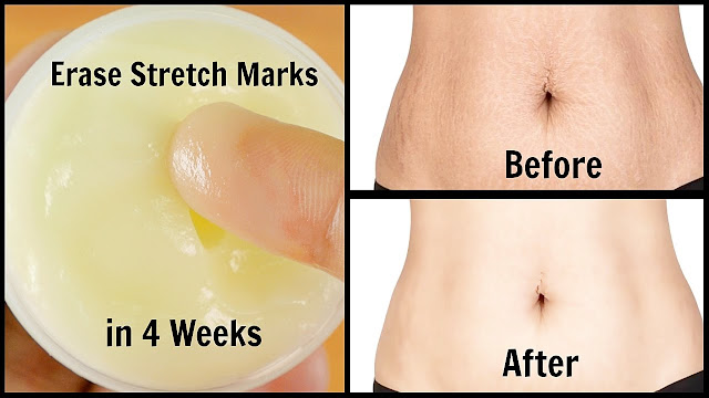 Hanya 6 Hari Stretch Mark di Perut Hilang Dengan 16 Bahan Alami ini Efektif dan Ampuh Hanya 6 Hari Stretch Mark di Perut Hilang Dengan 16 Bahan Alami ini Efektif dan Ampuh