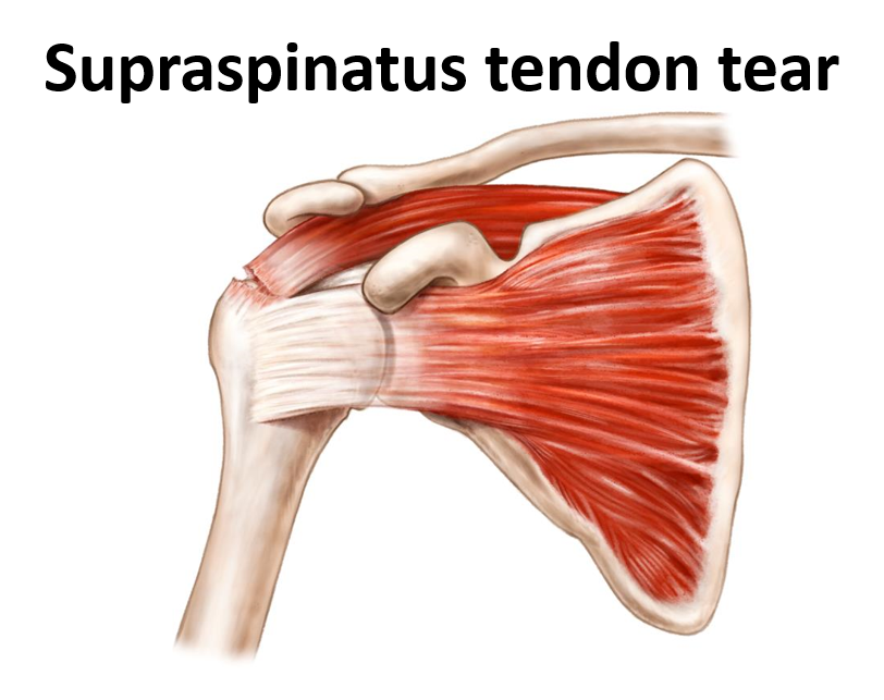 Partial Thickness Tear Supraspinatus Tendon