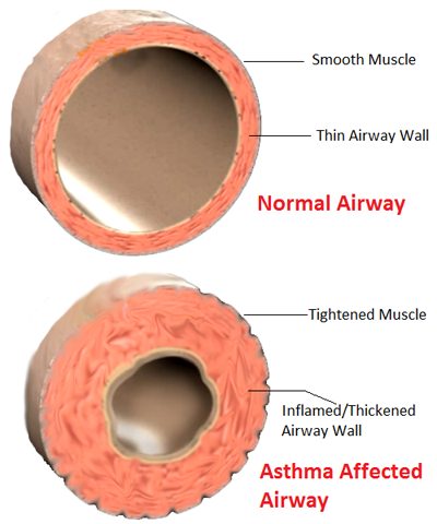 asthma induced narrowing of nasal passages
