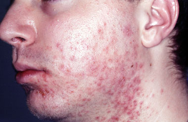 cure acne