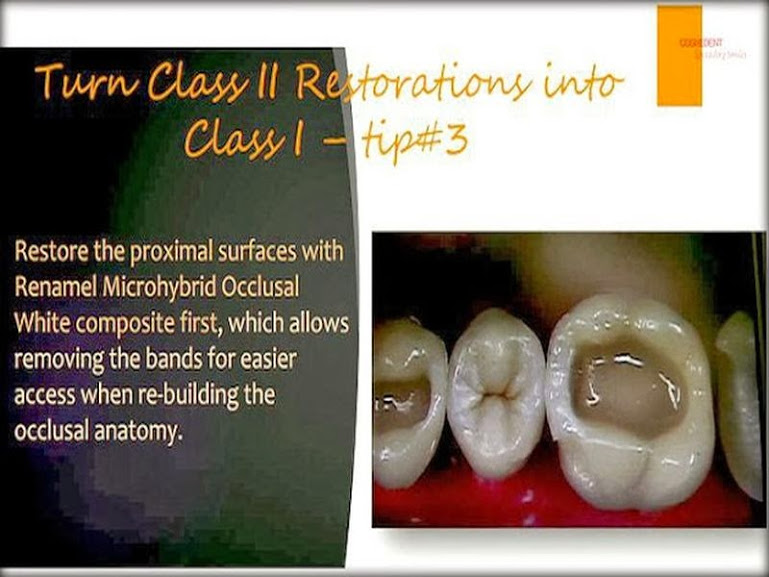 OPERATIVE DENTISTRY Class II composite restoration tips OdontoTv