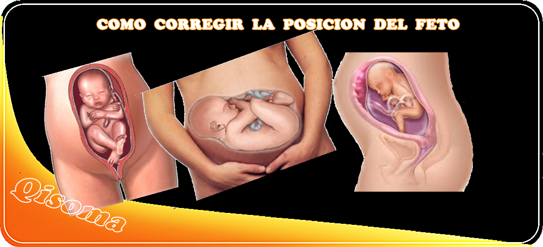 COMO CORREGIR LA MALPOSICION FETAL. moxibustion