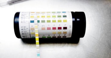 Causes of White Blood Cells in Urine